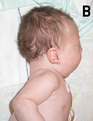 Noonan-szindrómás csecsemő: a fülek szokatlan helyzete jól látható