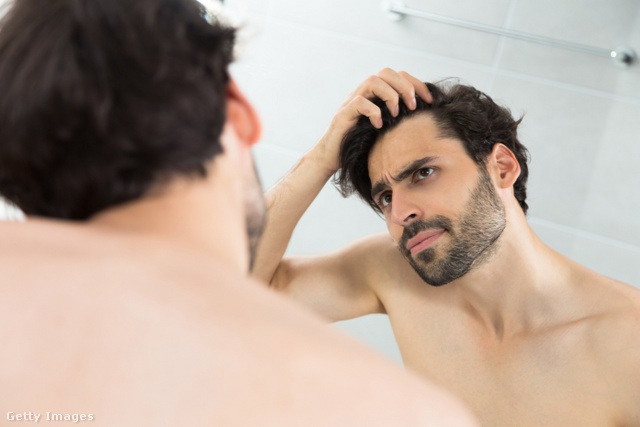 Sok férfit aggaszt a hajhullás