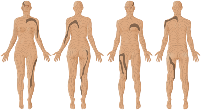 A Blaschko-vonalak az emberi testen