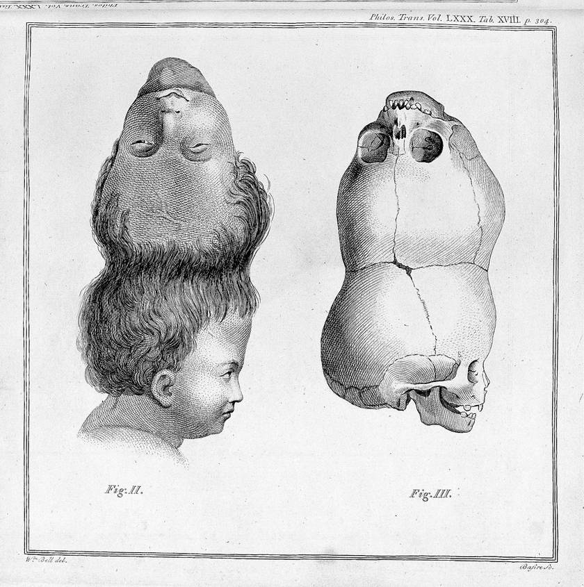 E. Home; An account of a child with a double head. Wellcome L002