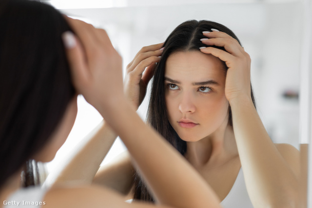 A nők hajhullását leggyakrabban genetikai vagy hormonális okok befolyásolják