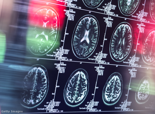 A magnéziumbevitel az agyra is hatással van, és fontos szerepet játszhat a demencia megelőzésében