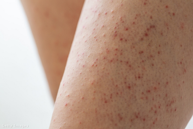 A keratosis pilaris nevű bőrbetegség piros, dudorszerű pöttyöket hagy a lábakon