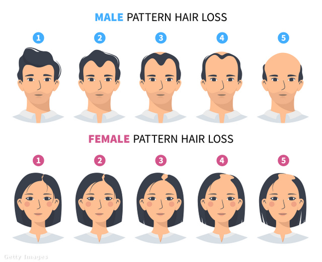 A hajhullás fázisai férfiaknál és nőknél