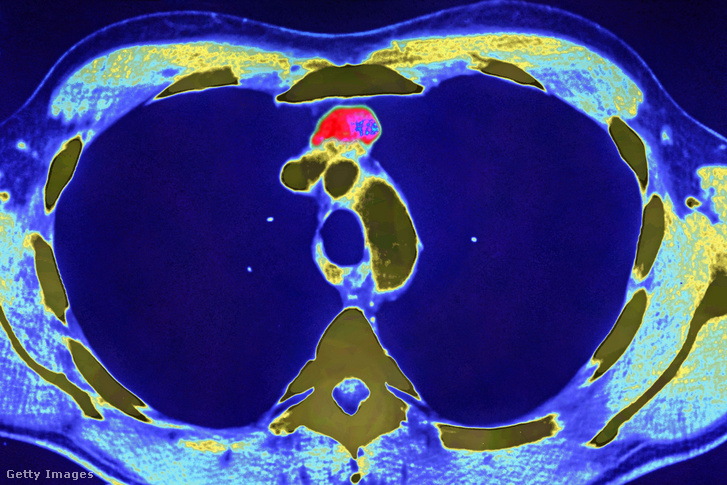 A mellkas keresztmetszeti CT-felvételén thymus látható 2018. január 18-án