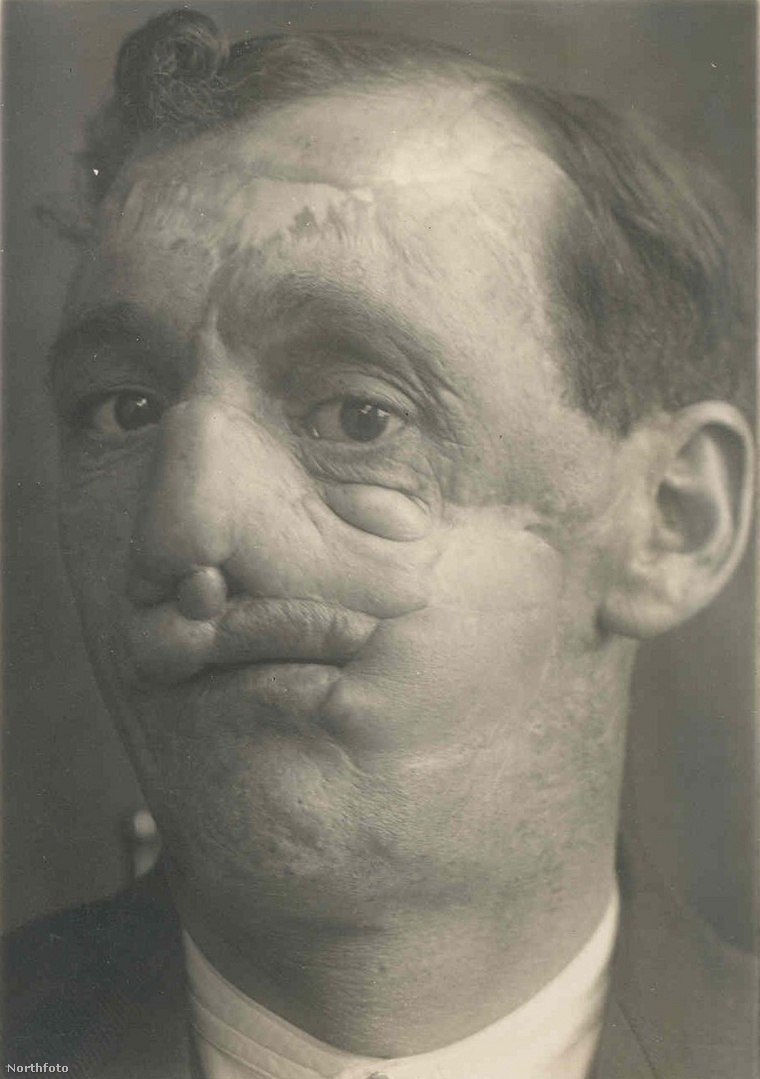 William Thomas közlegény arca a műtétjét követően, 1924. június 16-án.  (Fotó: RCS / Helion Company / mediadrumworld.com / Northfoto)