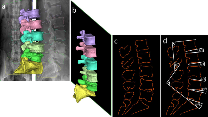 Új módszer fekvő CT-alapú virtuális 3D gerincmodellek ágyéki lordózisának álló röntgenfelvételhez való hozzáigazítására Hajnal B., Eltes P. E., Bereczki F., Turbucz M., Fayad J., Pokorni A. J., Lazary A. Nature Scientific Reports, 2022, 12(1), 20382.