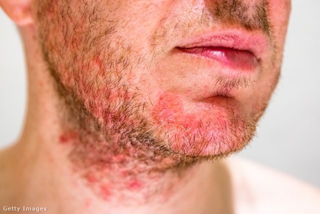A seborrheás dermatitis heves viszketéssel jár