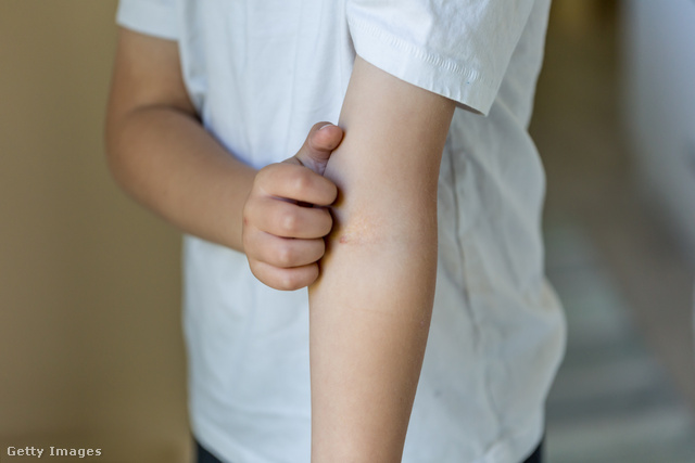 Az új kutatás szerint négy gyerekkori allergia, köztük az ekcéma, összefüggésbe hozható a bélbaktériumok állapotával