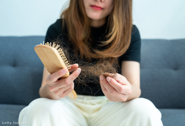 A hajhullás természetes, de a kopaszodás ijesztő is lehet