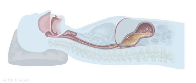 A hagyományos párnán való alvás a refluxos tünetek kialakulásának kedvez