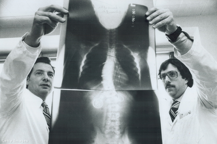 Orvosok egy kislány röntgenfelvételét vizsgálják 1976-ban
