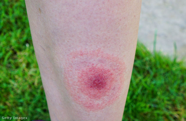 A kullancsok jelentette egyik legnagyobb veszély a Lyme-kór, ennek jellegzetes foltja látható a képen