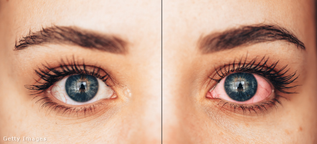 A szemhéj duzzanata gyakran a szem vörösségével párosul, ami gyulladásra, fertőzésre utalhat