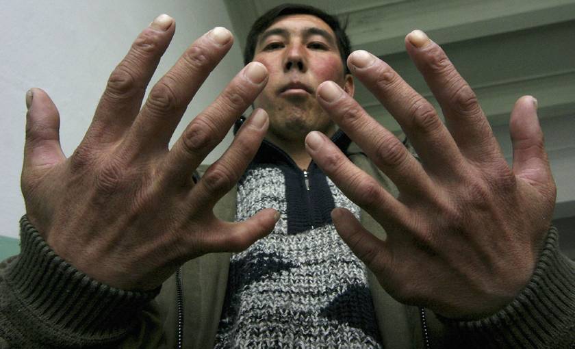 A közelben született Azamat Kazizovnak 12 ujja és 12 lábujja van.