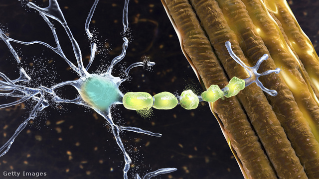 Az ALS a mozgató idegsejtekkel kapcsolatos problémák sorát jelenti