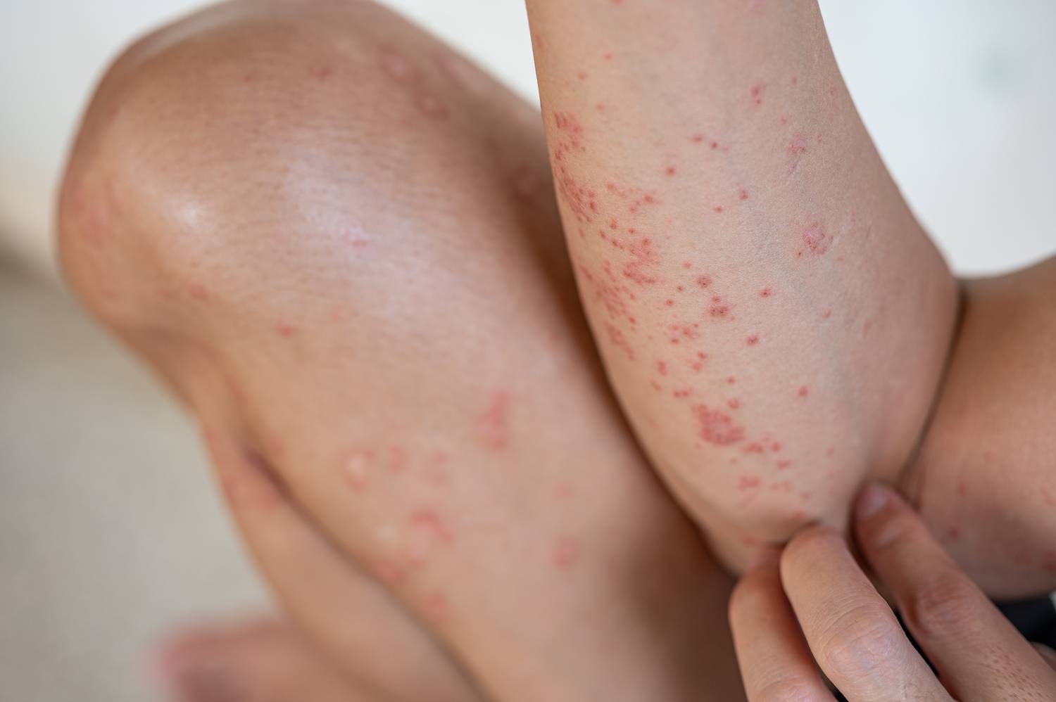 Ekcémás tünetek jelezhetik ezt a gondot: a szárazsággal, viszketéssel és hólyagosodó kiütésekkel járó dermatitis herpetiformis nevű bőrbetegség hátterében gyakran az autoimmun gluténérzékenység áll.