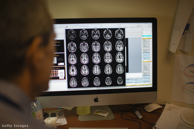 A tau-fehérjék a betegek agyában megzavarják az idegi működést