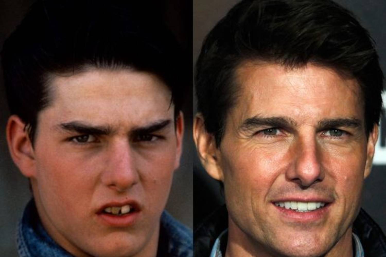 Tom Cruise fogai karrierje kezdetén még kuszák voltak, ahogy azonban egyre jobban befutott, megcsináltatta mosolyát, és ma már vakítóan fehér, tökéletes fogsorral hódít.