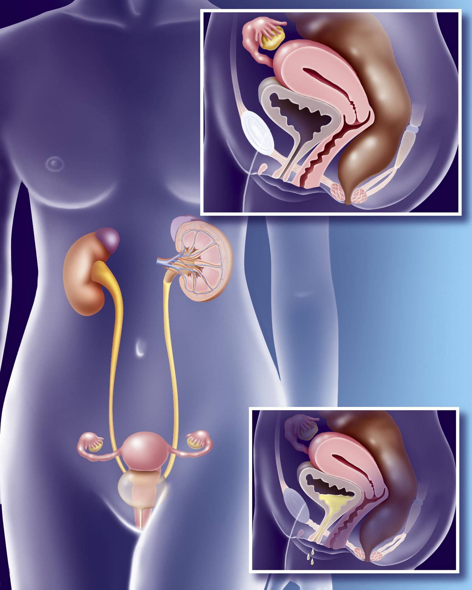 Inkontinencia torna nőknek (2)