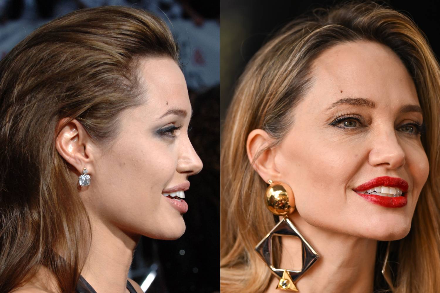 A ráncfelvarrás következtében a fülkagyló formája megváltozhat, Jolie esetében is erre hívta fel a figyelmet a szakértő.