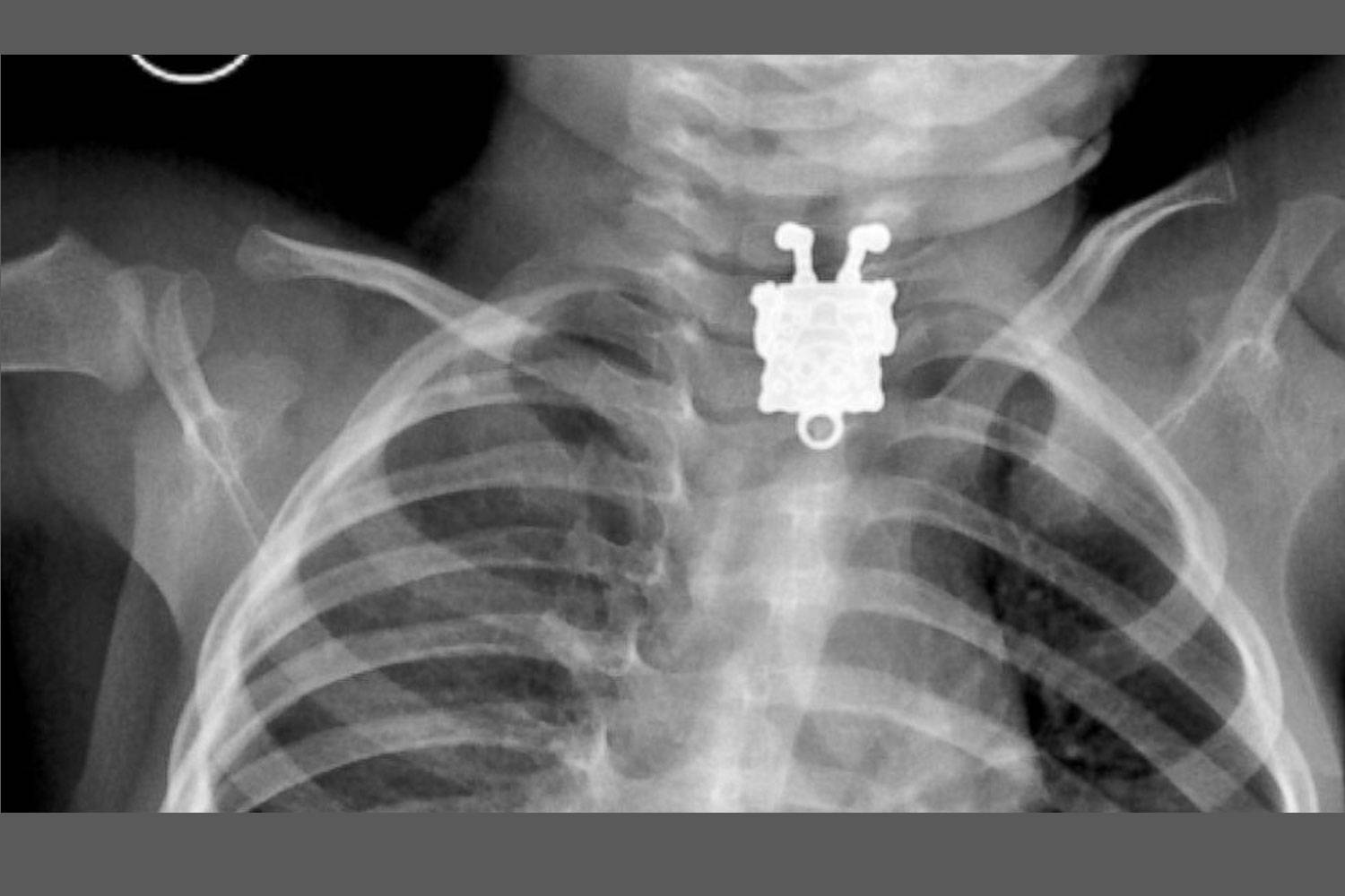 A röntgenfelvételen tisztán látszik SpongyaBob Kockanadrág a totyogós gyerek nyelőcsövében.