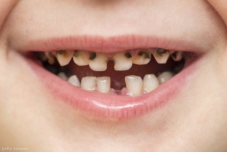 A fogszuvasodás a helytelen táplálkozás és a fogápolás hiányának a következménye. (Fotó: Andrii Zorii / Getty Images Hungary)