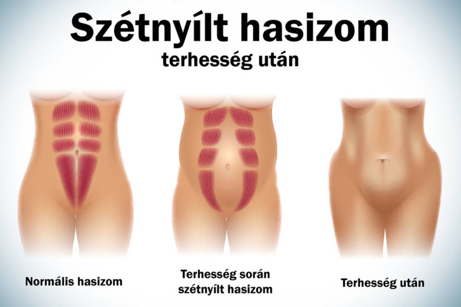 szetnyilt-hasizom-grafika