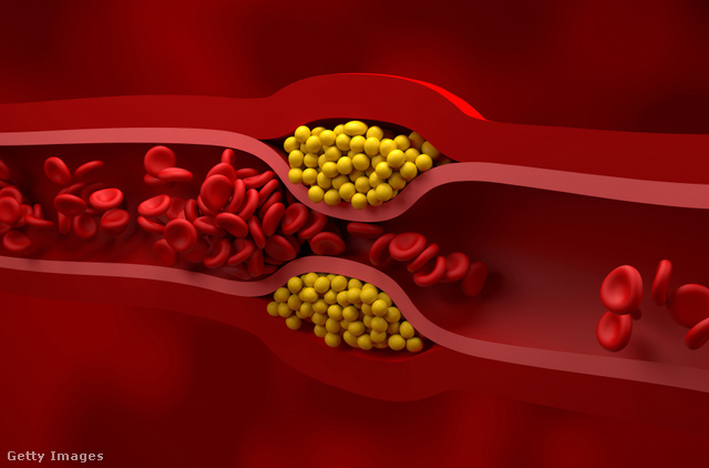 A vérben felhalmozódott koleszterin elzárhatja az artériákat