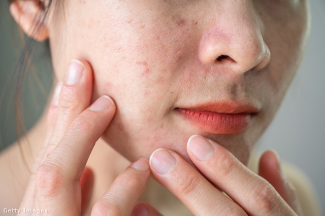 Kellemetlen bőrkiütést okozhat a túl sok B-vitamin