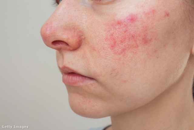 A parazita túlszaporodásának következménye lehet a rosacea is