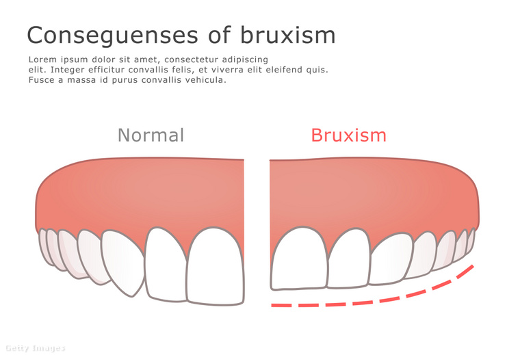 Egészséges fogak vs. bruxizmus (jobb oldali ábra). (Fotó: Refluo / Getty Images Hungary)