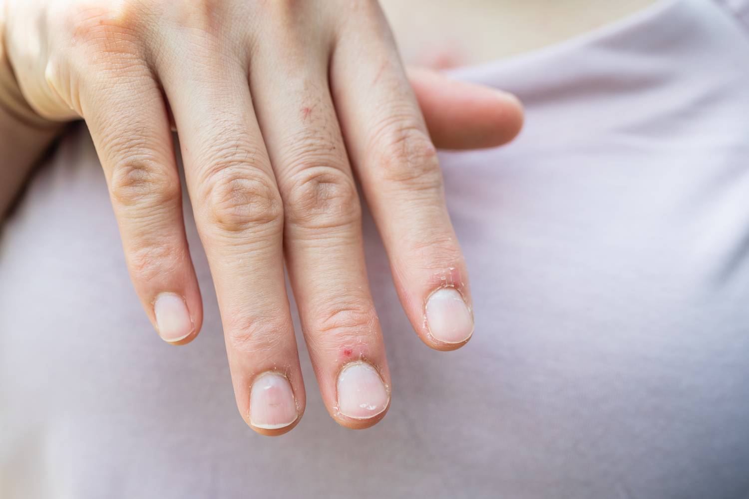 A megszokottnál halványabb körmök leginkább vashiányra, vérszegénységre, és néhány esetben vesebetegségekre utalhatnak.