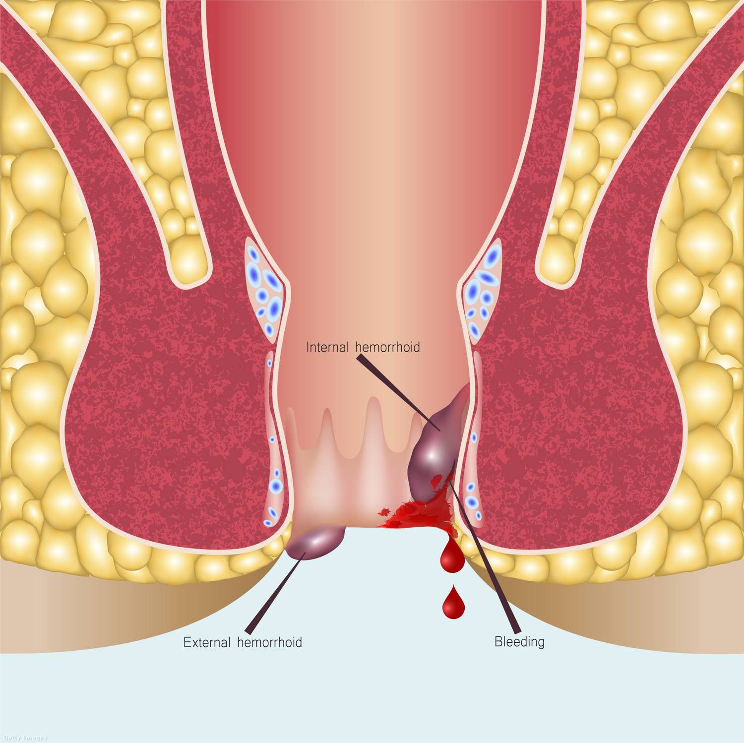 External hemorrhoid, azaz külső aranyér és az internal hemorrhoid, azaz a belső aranyér közti különbség.