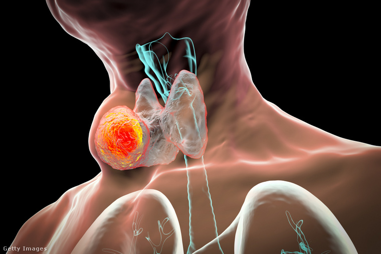 A pajzsmirigy a nyak alsó részén található szerv, amely hormonokat termel, így befolyásolja az anyagcserét, a szív működését és az emésztést. (Fotó: Kateryna Kon/science Photo Libra / Getty Images Hungary)