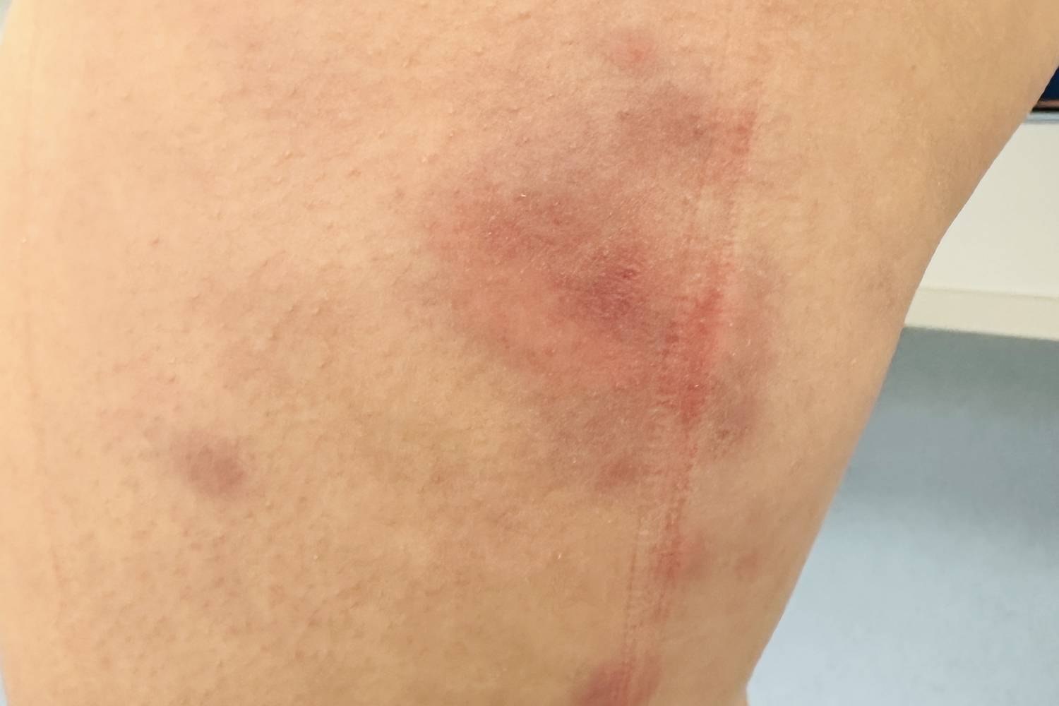 A fájdalmas, vörös csomók, melyek elsősorban a lábakon jelentkeznek, gyulladásos elváltozások következtében is kialakulhatnak. Az erythema nodosum megjelenése kapcsolódhat tüdőgyulladásos fertőzésekhez.