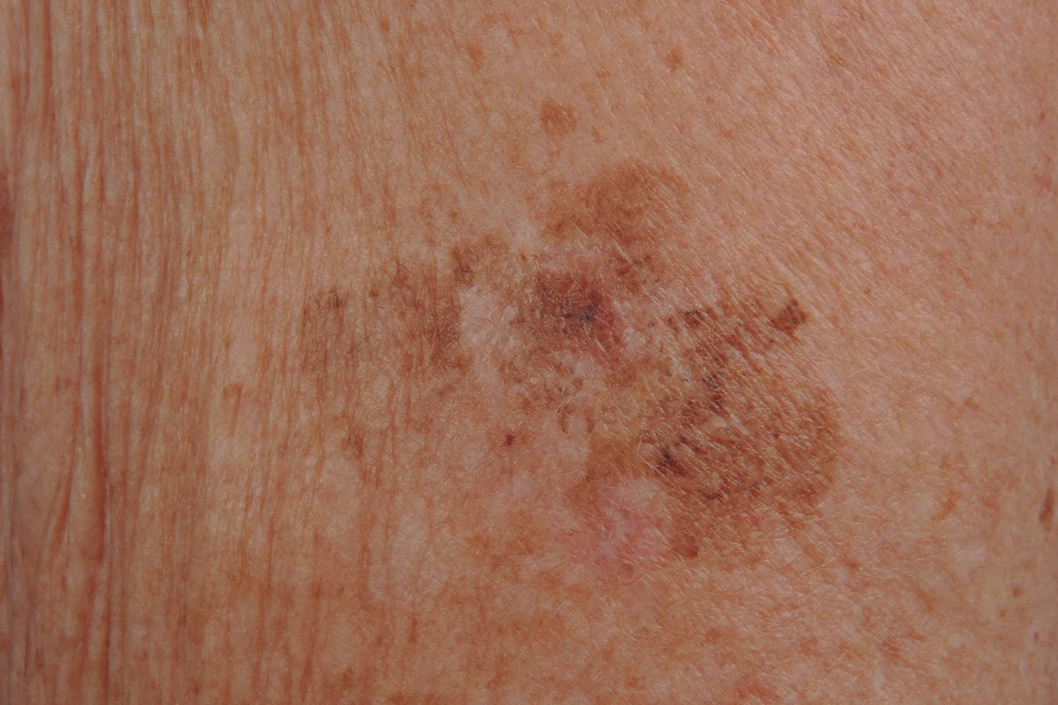 A lentigo maligna melanoma (Dubreiulh-melanoma) az idősebbeknél gyakori, főleg napkárosodott bőrfelületeken, például az arcon jelentkezik. Lassan növekszik, kezdetben lapos, barnás foltként látszik.