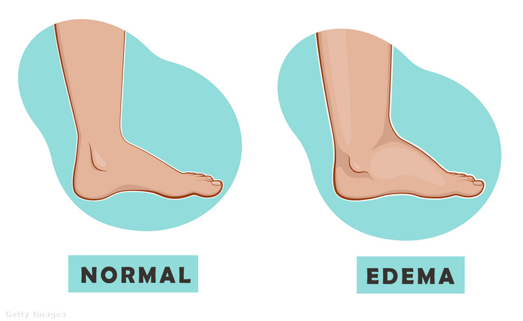 A láb duzzanata kellemetlen, sőt, akár fájdalmas is lehet. Ilyenkor folyadék halmozódik fel az egyik vagy mindkét láb szöveteiben, ami ödéma kialakulásához vezet. (Fotó: Chorna Olena / Getty Images Hungary)