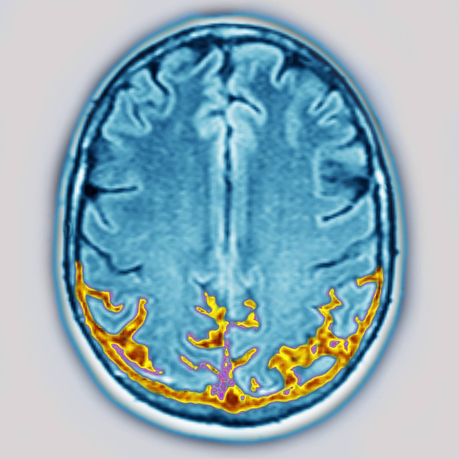 Apraxia tünetei 1