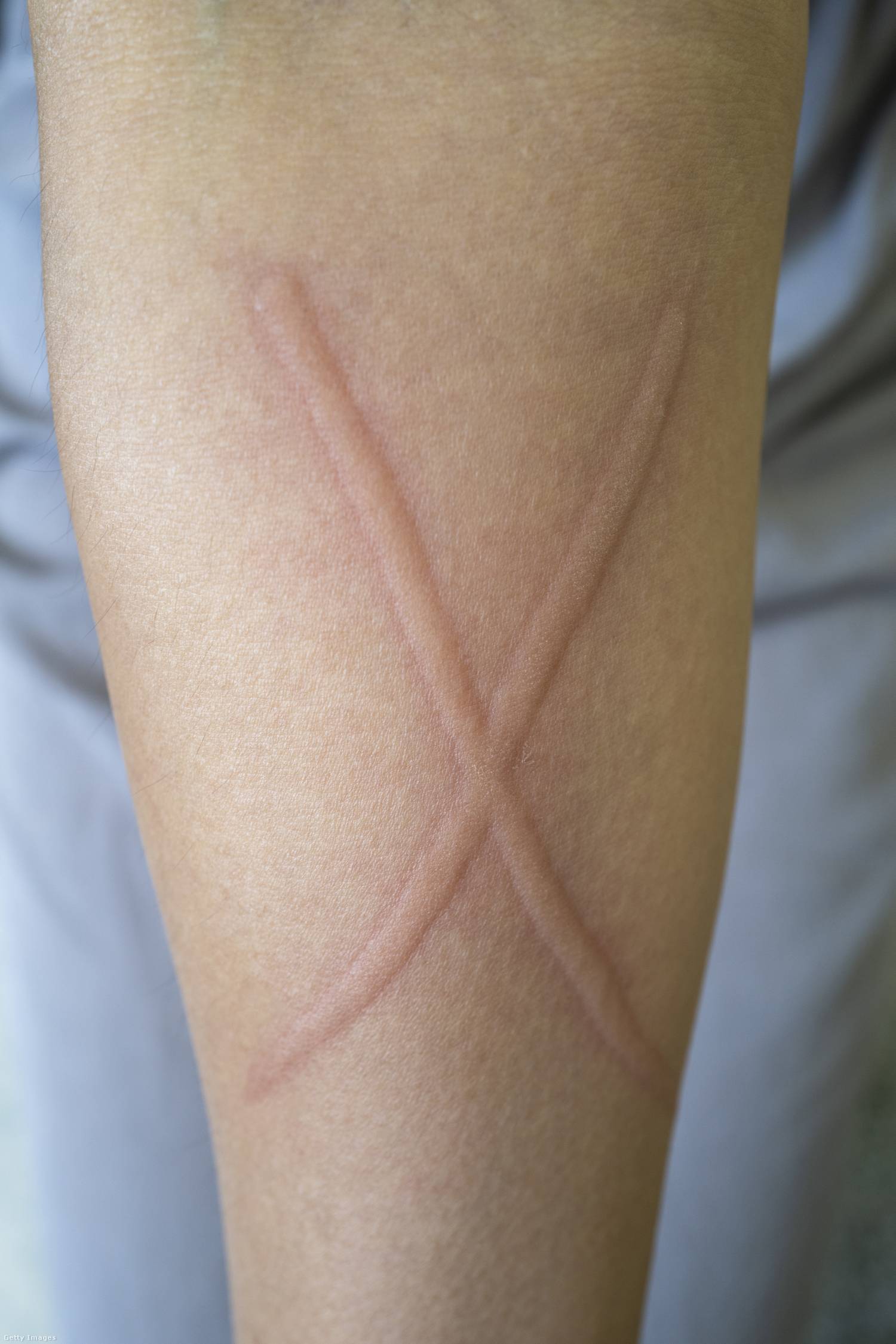 Dermatográfia kezelése 1