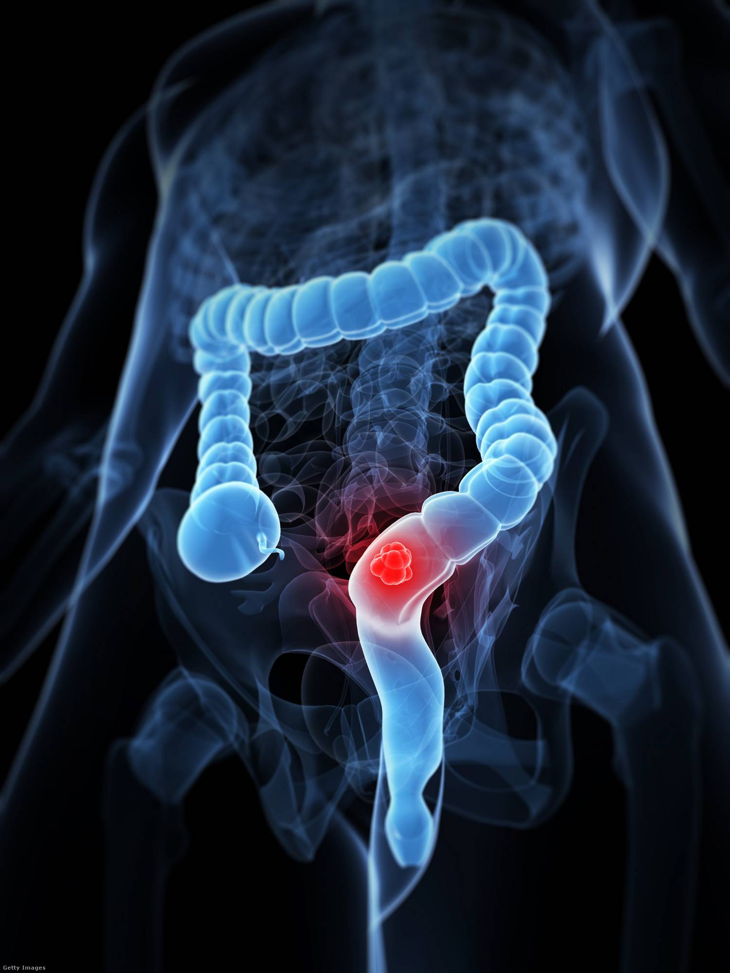 Vastagbélráktól véres széklet 1