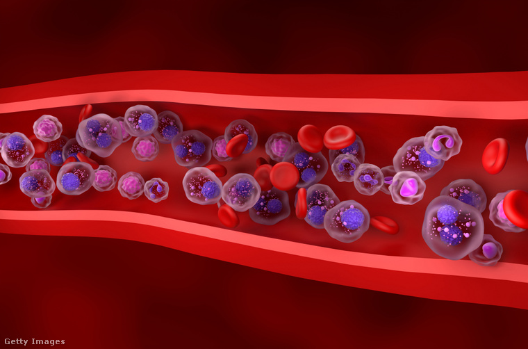 A myeloma multiplex a csontvelő plazmasejtjeinek, vagyis az ellenanyagokat termelő fehérvérsejtek daganatos megbetegedése. (Fotó: Nemes Laszlo / Getty Images Hungary)