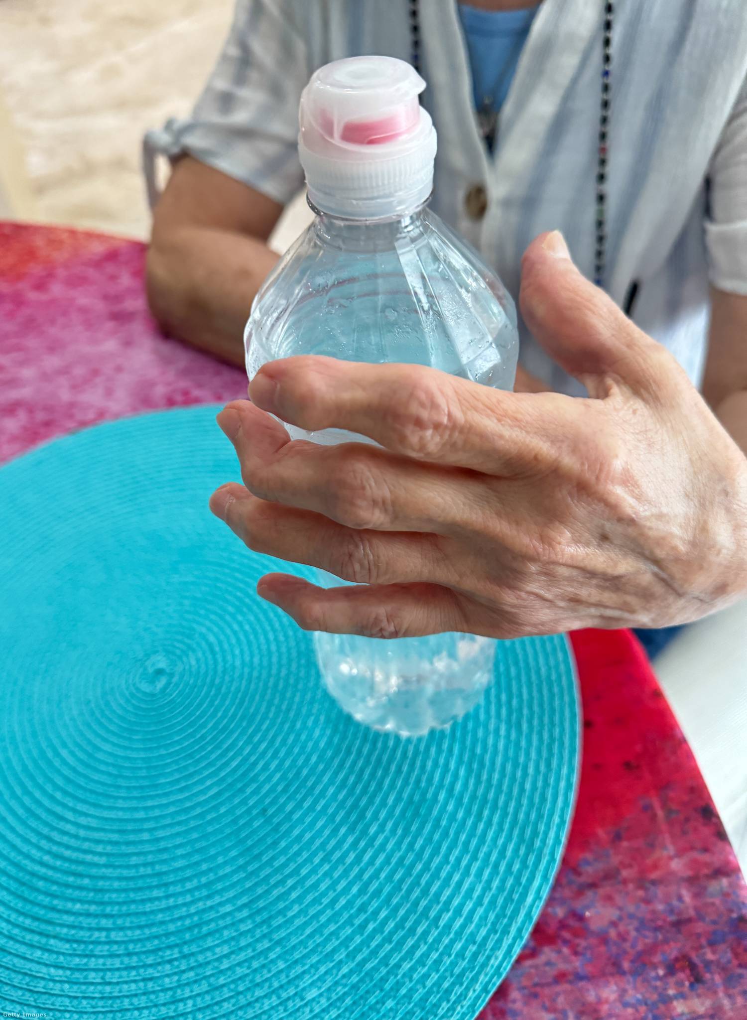 A rheumatoid arthritis