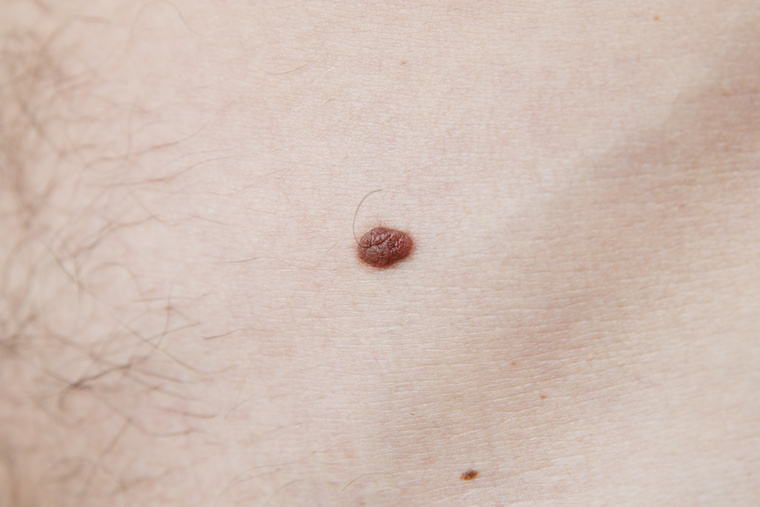 D - (diameter, azaz átmérő)Az egészséges anyajegy általában kis méretű, 6 mm-nél kisebb, ha azonban nagy méretű, 6 mm-nél nagyobb, akkor már érdemes megvizsgáltatni.