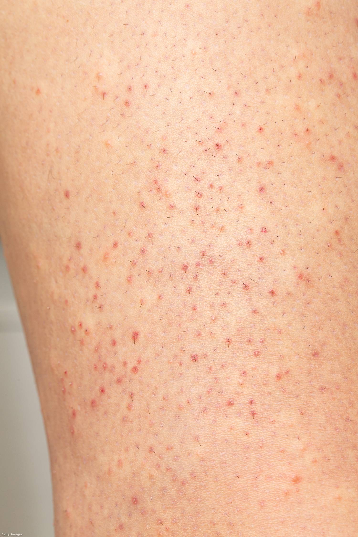 Keratosis pilaris csirkebőr ellen 1