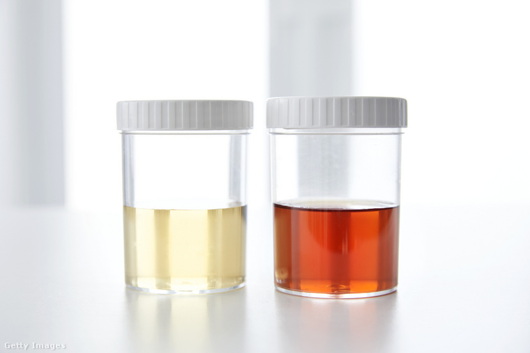 Vér a vizeletben&nbsp;A vizeletben megjelenő vér (hematuria) soha nem tekinthető normálisnak