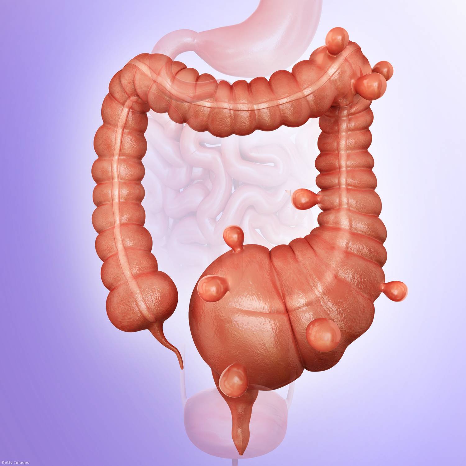 Vastagbél-diverticulosis tünetei 1