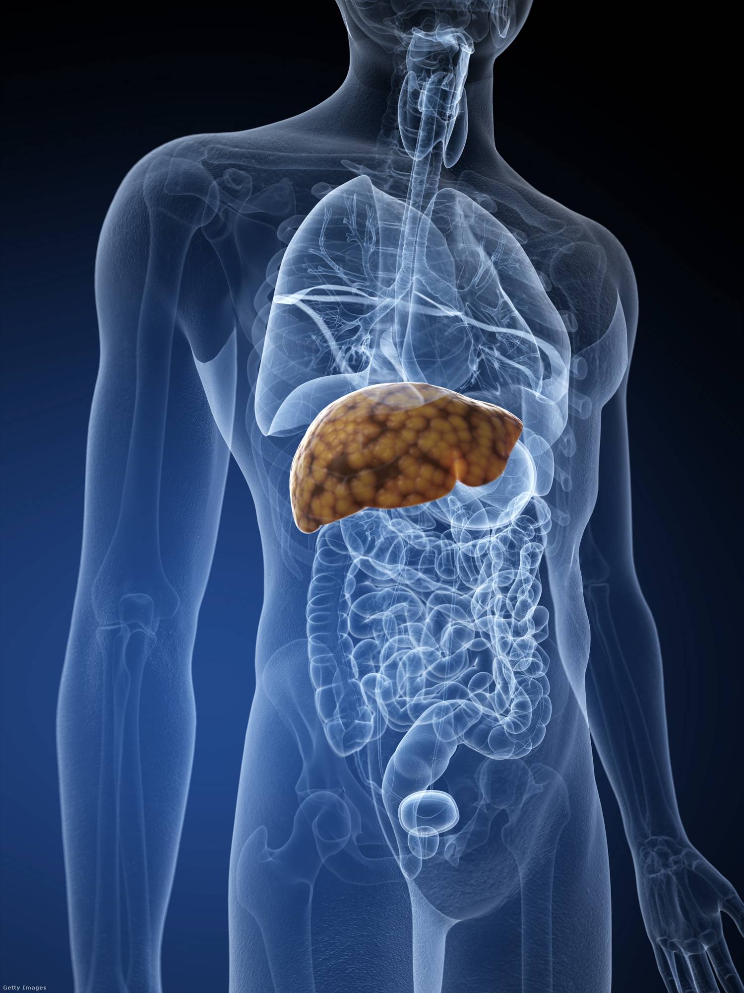 Metabolikus diszfunkcióval társult zsírmájbetegség tünetei 1