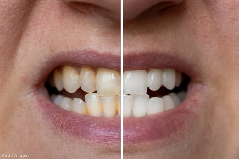 Nagyon fontos a napi kétszeri fogmosás ahhoz, hogy mosolyunk tökéletes maradjon. (Illusztráció: Getty Images)