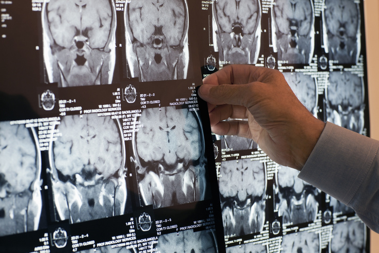 Ez a stroke korai tünete: akár hetekkel korábban figyelmeztethet a szervezet